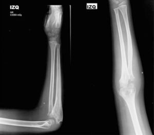 Radiografía de codo AP y lateral a los 6 meses tras la cirugía.