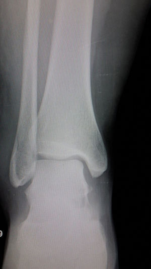 Radiografía AP de tobillo. Fractura Weber B.