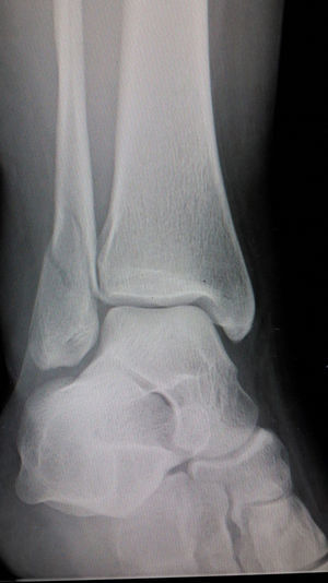Radiografía de mortaja del tobillo. Fractura Weber B.