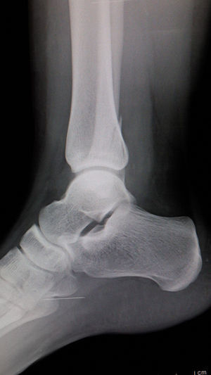 Radiografía lateral de tobillo. Fractura Weber B.