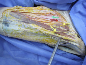 La flecha verde señala la vena femoral, la flecha roja señala la arteria femoral. Las flechas amarillas señalan estructuras nerviosas; la más lateral es el nervio femorocutáneo y la más medial el nervio femoral.