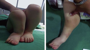 En la imagen derecha se aprecia la deformidad en valgo de la rodilla y en la izquierda, la discrepancia de miembros inferiores y el valgo del retropié.