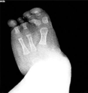 Radiografía AP del pie del paciente, en la cual se aprecia la presencia de 3 rayos.