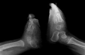 Radiografía lateral de los pies del paciente, en la cual se aprecia la superposición parcial del calcáneo con el astrágalo.