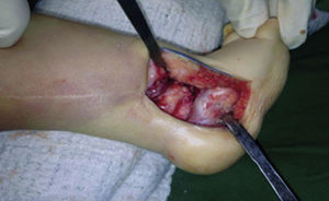 Se aprecian el extremo distal de la tibia articulado con el domo del astrágalo. Distalmente, el calcáneo está desplazado hacia externo. La localización anormal del calcáneo impide la visualización de la mitad inferior del astrágalo.