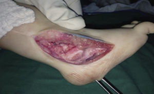 Luego de la osteotomía subtalar se aprecia cómo se visualiza la totalidad del talo con el calcáneo situado bajo su superficie plantar.