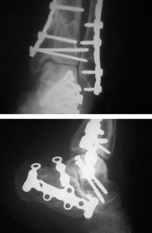 Control radiográfico a los 9 meses tras la intervención quirúrgica, consolidación definitiva y condiciones articulares muy satisfactorias de las articulaciones tibiotalar y subtalar.