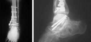 Radiografías posteriores al retiro de material de osteosíntesis de peroné y de calcáneo.