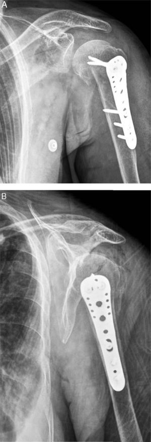 A) Radiografía anteroposterior de hombro izquierdo en el postoperatorio inmediato. B) Radiogrfía escapulohumeral de hombro izquierdo en el postoperatorio inmediato.