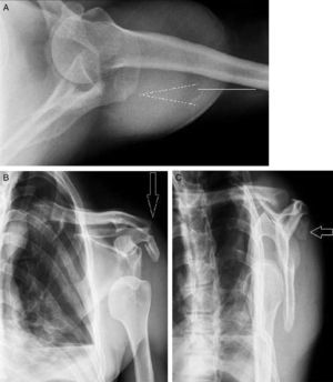 Radiografías iniciales con evidencia de luxación anterior del hombro y fractura desplazada del acromion (flecha). Proyección axilar (A), anteroposterior del hombro (B) y lateral de escápula (C).