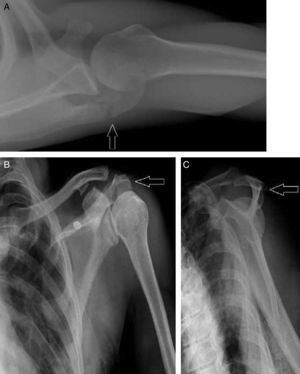 Radiografías de control posreducción con articulación congruente y fractura del acromion reducida (flecha). Proyección axilar (A), anteroposterior de hombro (B) y lateral de escápula (C).