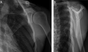 Control radiológico 8 semanas después con signos de consolidación de la fractura del acromion. Proyección anteroposterior del hombro (A) y lateral de escápula (B).