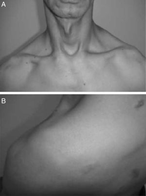 Fotografías del paciente 8 semanas después sin deformidades ni alteraciones en el contorno del hombro izquierdo. Vistas anteroposterior (A) y posterosuperior (B).