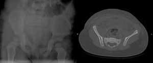 Radiografía (A) y TC (B) que confirman la rotura del anillo pélvico e inestabilidad multidireccional, con diástasis de la sínfisis púbica y de la articulación sacroilíaca izquierda.