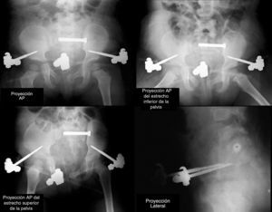 Radiografías intraoperatorias en proyección anteroposterior (AP), en los estrechos superior e inferior de la pelvis y lateral.