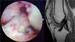 Imagen artroscópica y en resonancia magnética del aumento del haz posterolateral del ligamento cruzado anterior.