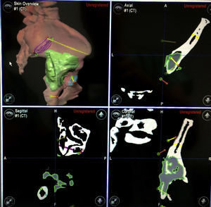 Planeamiento virtual. Condrosarcoma de pelvis en la región supraacetabular. Es posible segmentar el tumor (color verde), así como definir los planos de corte.
