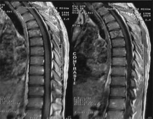 Imagen por resonancia magnética: infiltrados vertebrales T4, T5 y T6. Paciente de 13 años con LLA con fenotipo B. Dorsalgia.