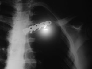 Radiografía de control posquirúrgico.