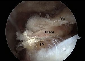 Visión por portal posterior de una lesión del manguito de los rotadores en riesgo de rerrotura y el bíceps tenotomizado distalmente para aumento y reconstrucción capsular superior. IE: infraespinoso; SE: supraespinoso; TM: tuberosidad mayor.
