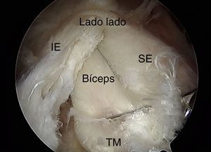 Visión por portal lateral del manguito de los rotadores en riesgo de rerrotura después del cierre de lado a lado con el aumento del bíceps antes de la inserción a hueso. IE: infraespinoso; SE: supraespinoso; TM: tuberosidad mayor.