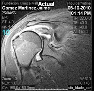 Resonancia magnética con lesión masiva e irreparable del supraespinoso que llega hasta el borde de la glenoides.