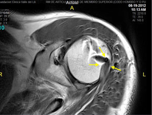 Control por resonancia magnética a los 6 meses de la transferencia del latissimus dorsi a la inserción del infraespinoso. El tendón se observa viable e inserto en el hueso.