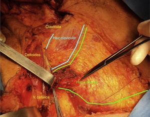 El haz clavicular y esternal del pectoralis major (PM) en una transferencia del PM al cuello por cáncer. Cortesía del Dr. Fernando Tintinago.