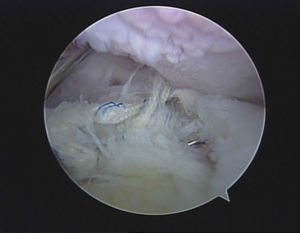 Imagen artroscópica de lesión del manguito de los rotadores.