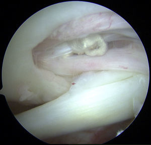 Imagen artroscópica de lesión del manguito de los rotadores.
