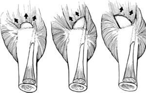 Tipos de roturas. Tomado de Habermeyer P, Magosch P, Lichtenberg S. Classifications and score of the Shoulder. Heidelberg: Springer; 2006.