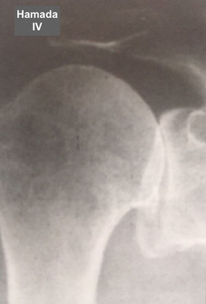 Grado 4 de la clasificación de Hamada.
