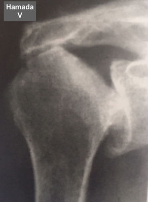 Grado 5 de la clasificación de Hamada.