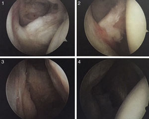 Clasificación de las roturas del subescapular. Grados I-IV.