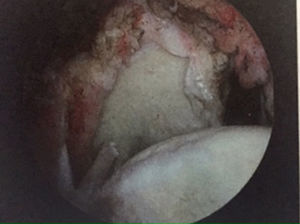 Rotura del subescapular. Grado V.