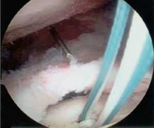 Técnica de una fila.