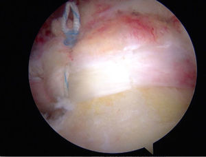 Fila única; sutura final.