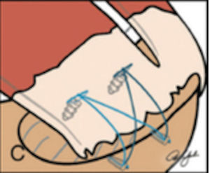 Esquema de doble fila. Tomado de Ferry AT, Provencher MT, Yanke A, Verma NN, Bach BR, Romeo A. Double-row rotator cuff repairs: Biomechanical rationale and surgical techniques. En: Warren RF, Craig EV, eds. Techniques in shoulder and elbow surgery. Vol. 9. Philadelphia: Lippincott Williams & Wilkins; 2009. p. 2.