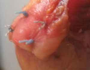 Doble fila anatómica.