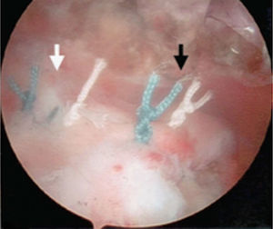 Doble fila artroscópica.