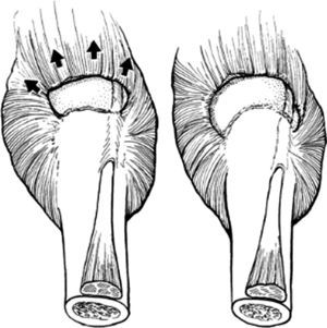 Tipos de roturas de tipo I. Tomado de Habermeyer P, Magosch P, Lichtenberg S. Classifications and score of the Shoulder. Heidelberg: Springer; 2006.