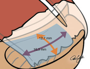 Esquema de la huella. Tomado de Ferry AT, Provencher MT, Yanke A, Verma NN, Bach BR, Romeo A. Double-row rotator cuff repairs: Biomechanical rationale and surgical techniques. En: Warren RF, Craig EV, eds. Techniques in shoulder and elbow surgery. Vol. 9. Philadelphia: Lippincott Williams & Wilkins; 2009. p. 2.