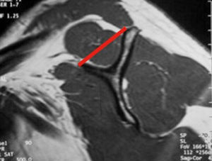 Infiltración de grado I.