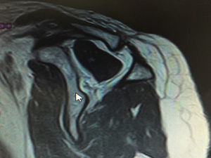 Infiltración de grado II.