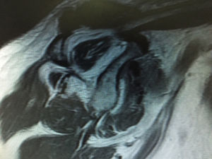 Infiltración de grado III.