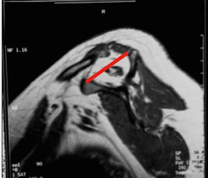 Infiltración de grado IV.