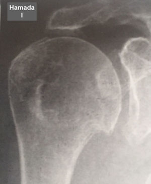 Grado 1 de la clasificación de Hamada.