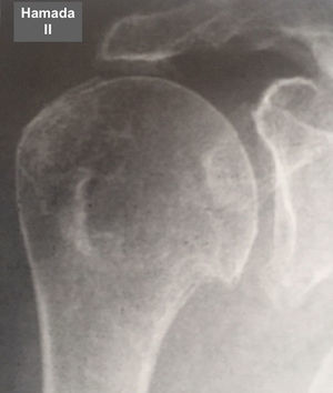 Grado 2 de la clasificación de Hamada.