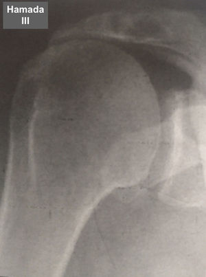 Grado 3 de la clasificación de Hamada.