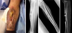 Lesión de aspecto ulceroso longitudinal (10-15 cm) a nivel pretibial de pierna derecha con supuración y reacción exofítica en su interior (izquierda). Radiografía a su llegada a urgencias con lesión de cortical anterior de tibia en su tercio medio (centro). Tomografía computarizada en que se observa la desestructuración ósea pretibial compatible con osteomielitis crónica (derecha).